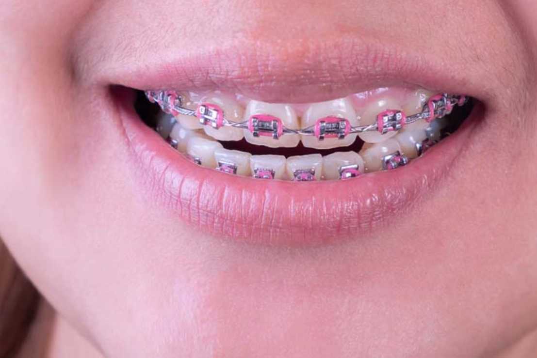 can you eat sushi with braces